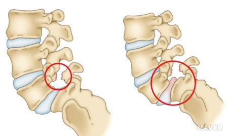 [척추분리증과 척추전방전위증] #척추전방전위증예방 #척추분리증운동